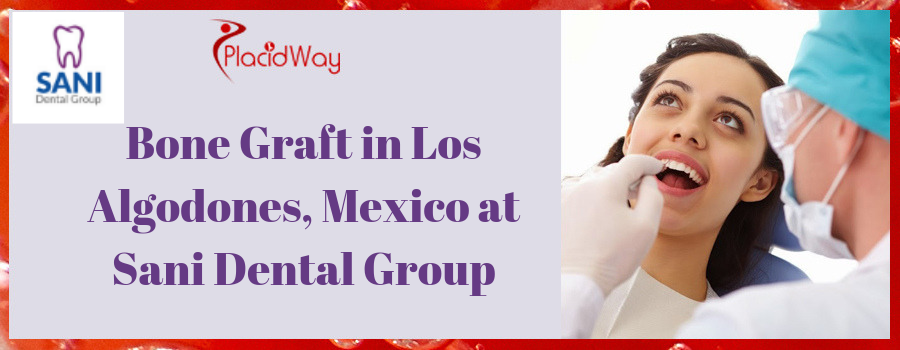 Best Bone Graft Option in Los Algodones Mexico